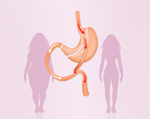 Gastrički Bypass